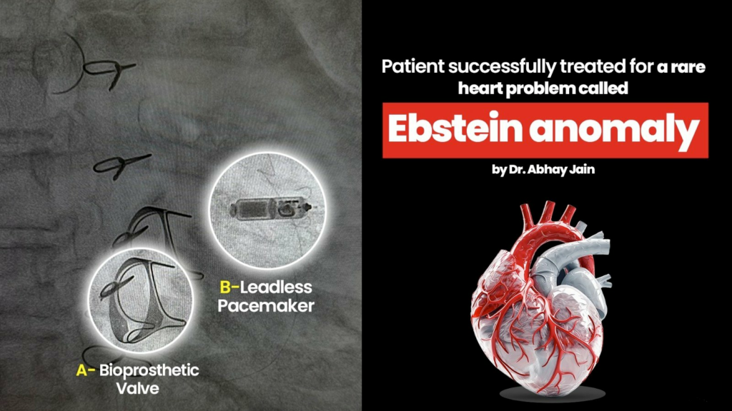 Patient successfully treated for a rare heart problem called Ebstein anomaly by Dr. Abhay Jain