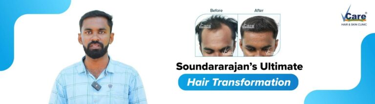 REVERSING BALDNESS WITH VCARE 