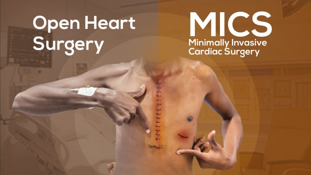 Transforming Heart Care: A Traveler’s Guide to Minimally Invasive Cardiac Surgery