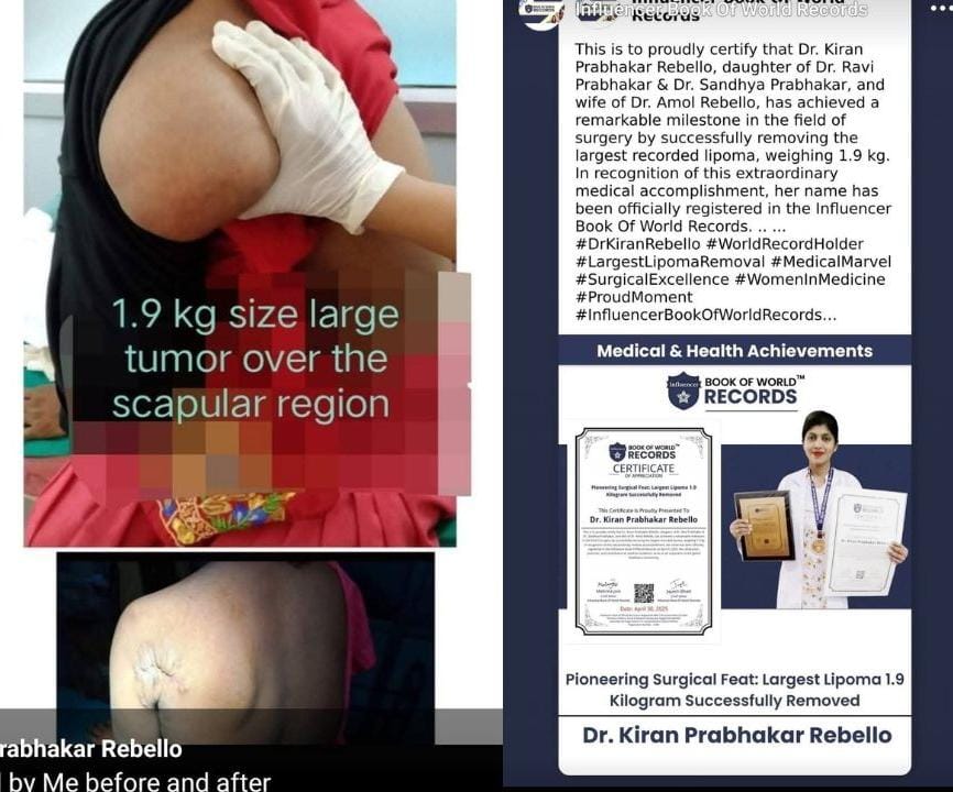Dr. Kiran Prabhakar Rebello Achieves Historic Surgical Feat: Successfully Removes Largest Lipoma Weighing 1.9 Kilograms