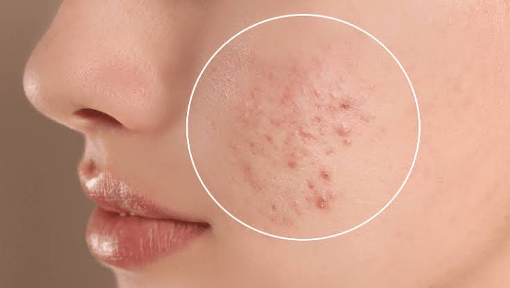 How to Treat Acne and Pigmentation?
