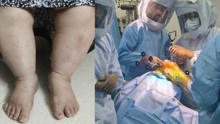 From 140 KGs and Years of Knee Pain to Walking Freely: Dr. Saikat Jena Restores a Woman’s Life with Surgery
