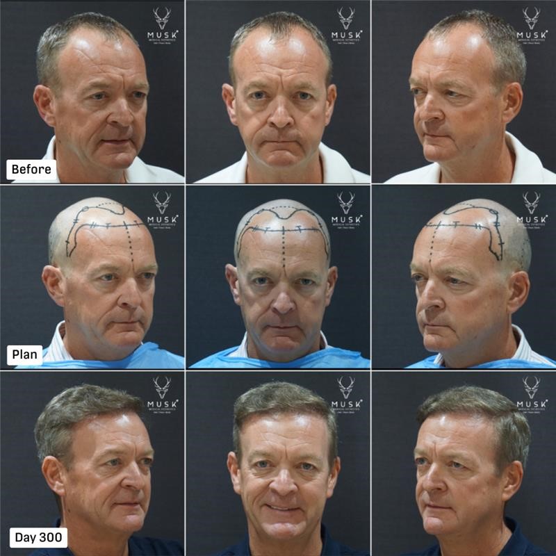 India’s Medical Tourism Boom: How Musk Clinic is Shaping the Global Aesthetics & Hair Restoration Demand