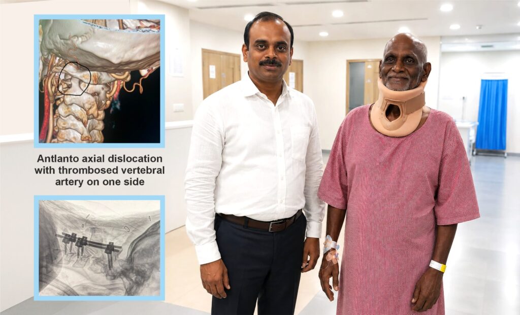Medicover Hospitals Neurosurgeon Successfully Treats 72-Year-Old with Life-Threatening Cervical Spine Injury